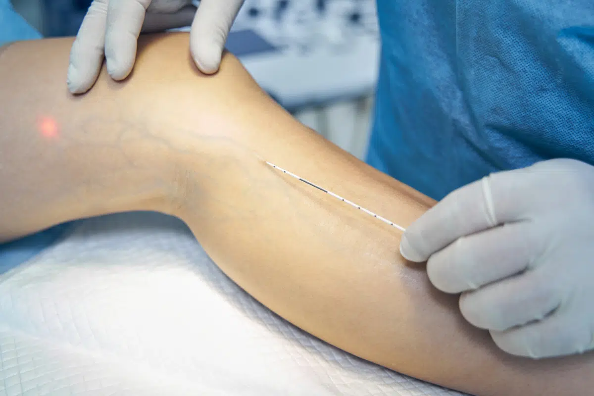 éliminer varices